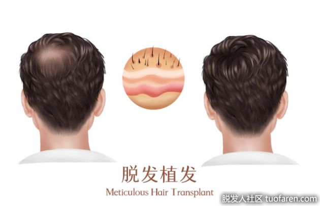 【圖】大麥植髮為您解答：植髮手術的優勢有哪些？