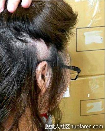 【圖】根治「鬼剃頭」舒緩壓力很重要