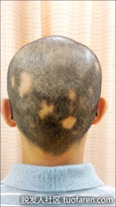 【圖】年紀輕輕鬼剃頭 中醫有辦「發」