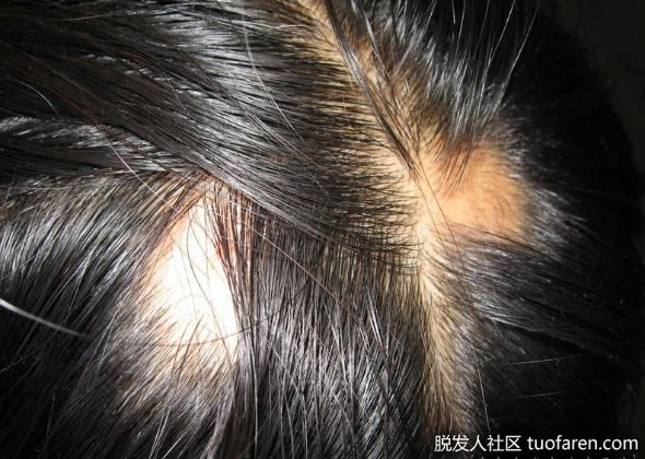 【圖】52歲婦女突然鬼剃頭 針灸長出新髮