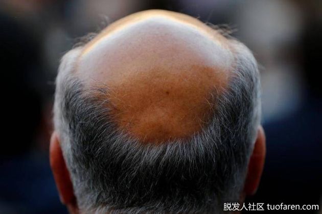 【圖】男性壓力大引發掉髮、性功能障礙 中醫：血液循環是重點