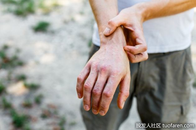 【圖】異位性皮炎、脂溢性皮炎傻傻分不清楚？醫：一張表看懂兩種皮炎差異，細心照護並不難！