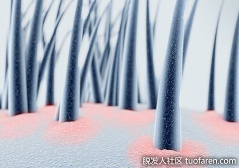 【圖】什麼是脂溢性皮炎 原因 症狀 併發症 好發族羣 預防