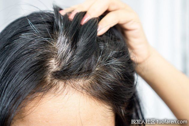 【圖】白髮狂冒？年紀輕就白髮？營養師揭「3大元兇」：想預防就吃這些