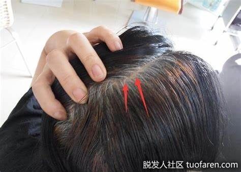 【圖】白髮是天生？醫師説還有這些原因易造成白髮