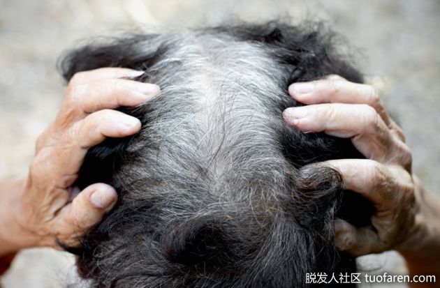 【圖】提早出現「滿頭白髮」 醫師提醒：骨質疏鬆、心臟病恐找上門