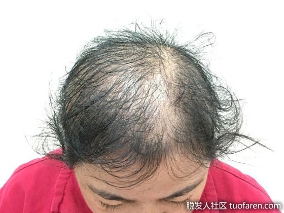 【圖】年輕女生狂掉髮 半數減重造成