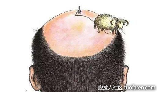 【圖】雄性脱髮基因遺傳 也會來自母系