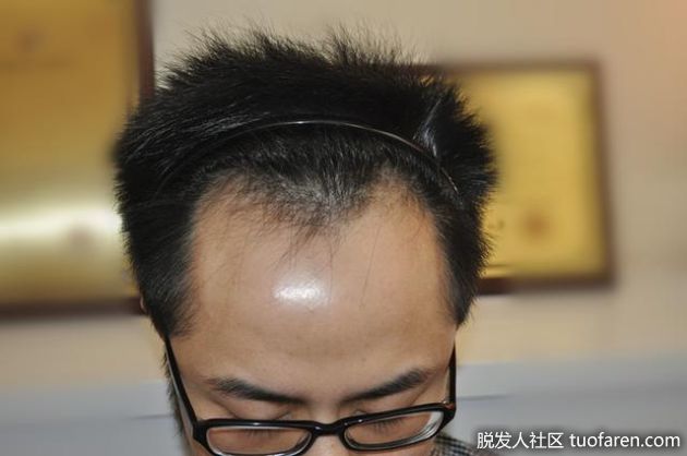 【圖】按摩梳頭依舊禿頂 靠植髮救M字額