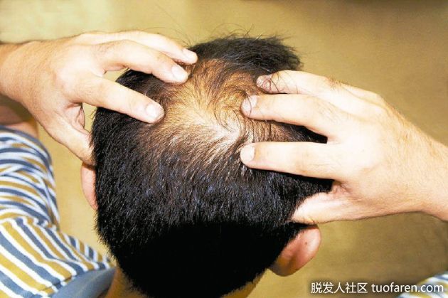 【圖】養髮液、生髮液大不同！醫師教你如何分辨頭頂上的需求