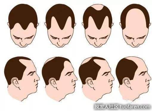 【圖】抒壓、少熬夜 遠離雄性脱髮