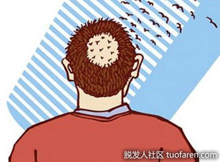 【圖】年輕人脱髮 不建議服藥預防