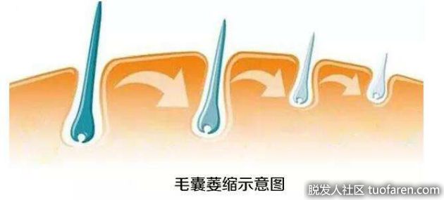 【圖】搶救毛囊 別等掉髮後…