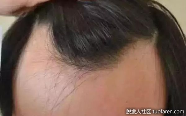 【圖】發線後退、掉髮增多 最好快看皮膚科