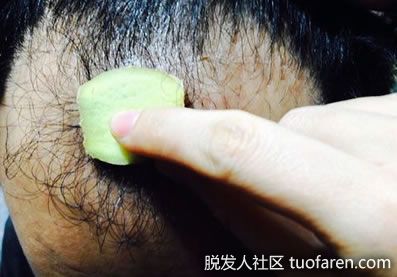 【圖】28歲男為了治禿頂抹生薑、擦啤酒