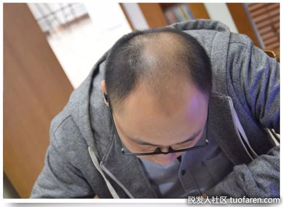 【圖】高中生像大叔…雄性脱髮年輕化