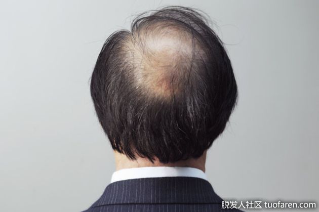 【圖】髮量稀疏?懂得紓壓 解除掉髮危機