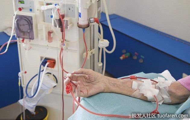 【圖】Q&A/洗腎、內分泌問題 會影響掉髮嗎？