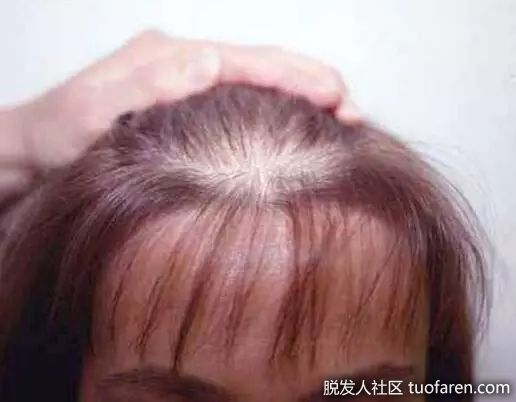 【圖】頭皮提早老化?小心髮量不保!