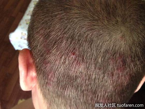 【圖】頭皮長痘痘?脂溢性毛囊炎作怪