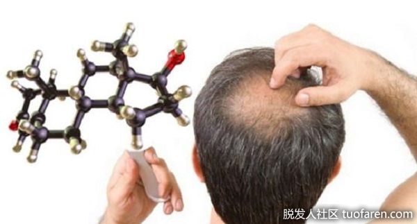 【圖】治療雄性脱髮 把握黃金期