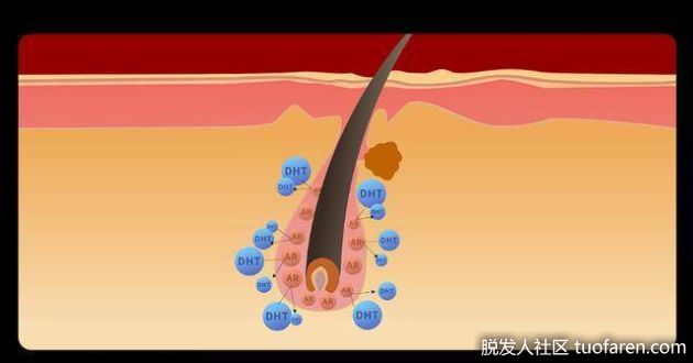 【圖】什麼是雄性脱髮？