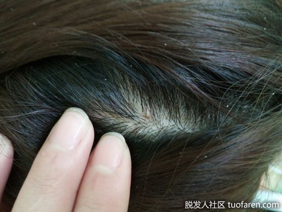 【圖】頭皮屑是什麼？