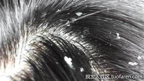 【圖】什麼是脂溢性皮膚炎