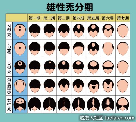 【圖】雄性脱髮怎麼辦?本文完整收錄原因、前兆及治療方法，找回烏黑秀髮