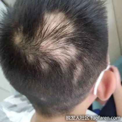 【圖】虎爸打罵壓力大 4歲童嚇出圓形禿