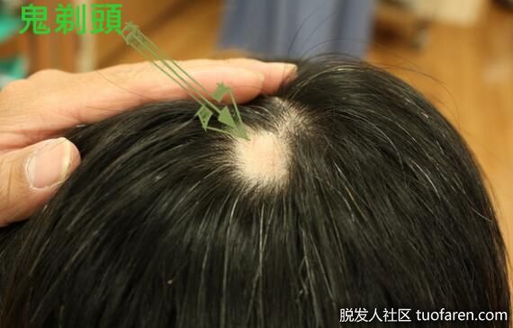 【圖】一夕之間頭髮就禿了一大塊 發生「鬼剃頭」該怎麼辦？