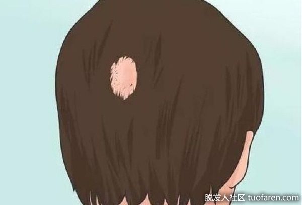 【圖】突遭鬼剃頭 自體免疫拉警報