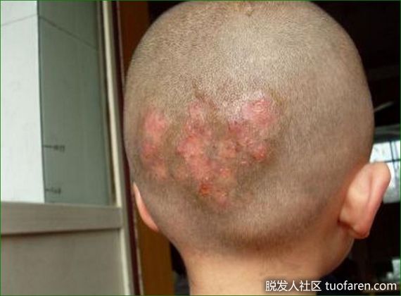 【圖】頭癬 青春期前好發