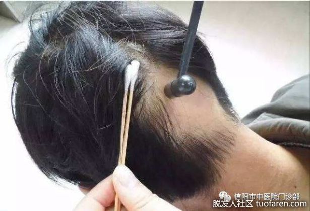 【圖】七星針(梅花針)叩刺，治療斑禿、髮際線後移