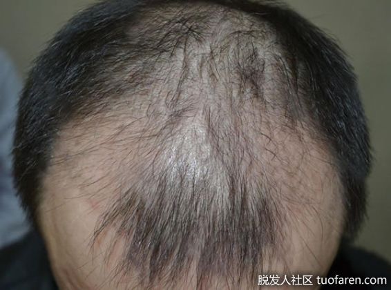 【圖】季節交替 雄性脱髮增二成