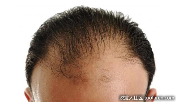 【圖】脱髮原因原來是「它」？從根本解決才能挽救秀髮！