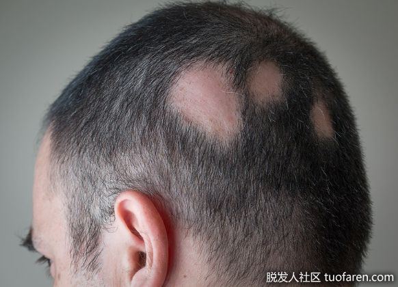 【圖】斑禿的三個特點