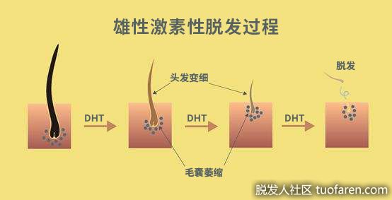 【圖】雄性脱髮的７個階段，你在哪一階？