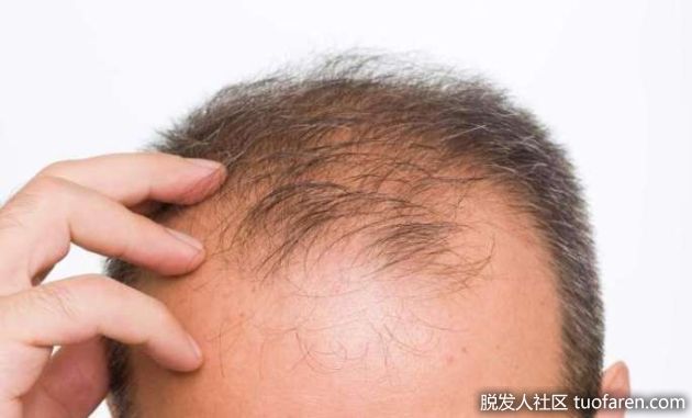 【圖】研究：脱髮者治療四月 頭髮平均再生92%