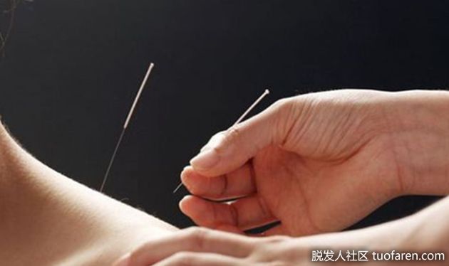 【圖】失眠導致雄性脱髮 針灸可治療
