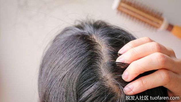 【圖】這8個問題會導致頭髮脱落