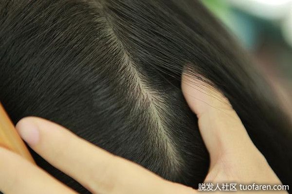 【圖】瞭解頭皮健康 掌握養髮關鍵5大重點