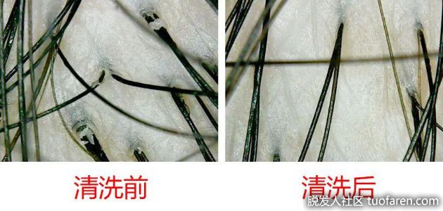 【圖】想擁有豐盈潤澤秀髮 頭皮清潔很重要