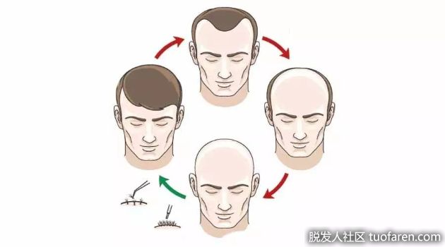 【圖】7成脱髮男延誤治療 小心鬼剃頭髮掉光