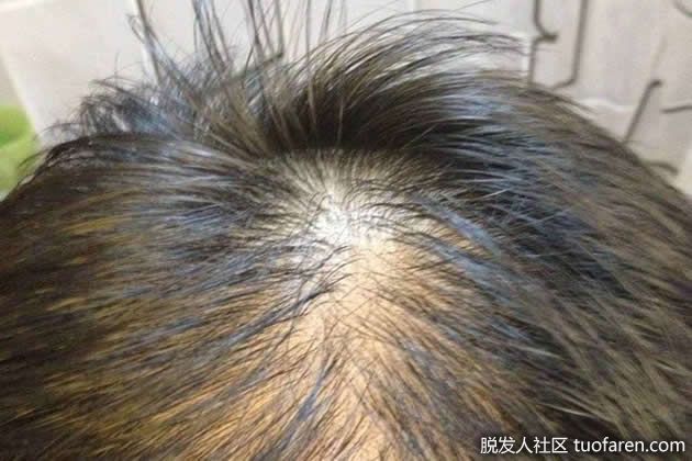 【圖】如何改善脱髮問題呢?脱髮如何是好呢?