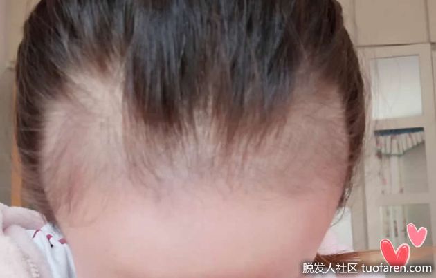 【圖】產後脱髮不用慌 瞭解產後脱髮原因是什麼