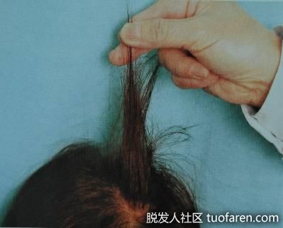 【圖】年輕人為掉頭髮煩惱 每天掉多少頭髮才算脱髮