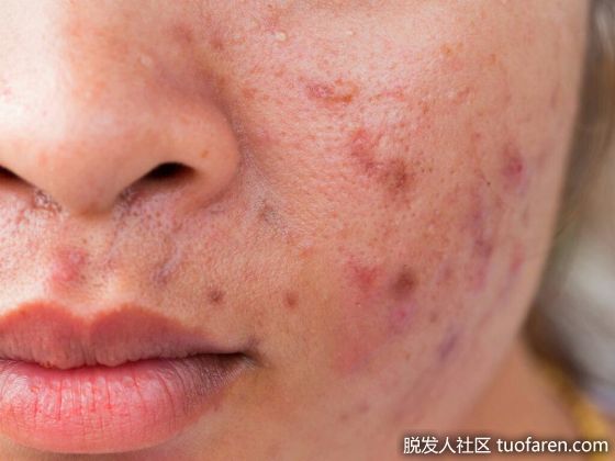 【圖】異維A酸（用於嚴重痤瘡）的好處