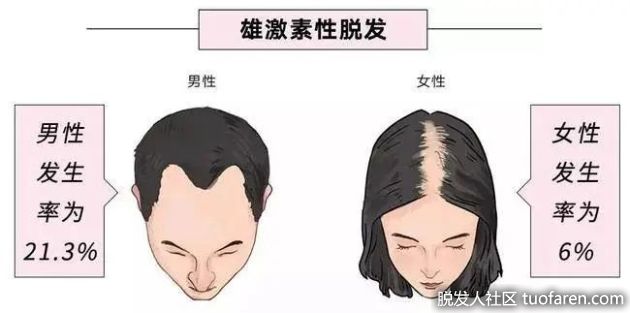 【圖】女性也有雄性脱髮 多開始於30至40歲間