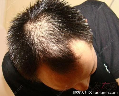 【圖】男性脱髮——少年老成的煩惱